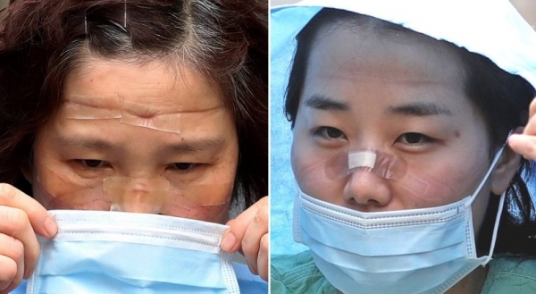 고글, 마스크 등 보호장구 착용으로 의료진들의 얼굴에는 고글 자국이 깊게 팼다/사진=NTD Korea